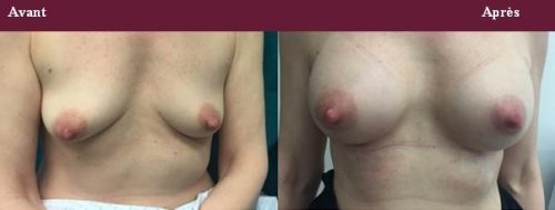 chirurgie seins traitement des seins tubéreux et asymétriques 