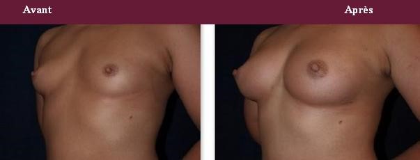 Lipofilling des seins Injection de graisse autologue Augmentation mammaire sans prothèses 